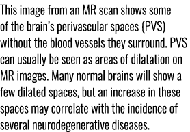 This image from an MR scan shows some of the brain’s perivascular spaces (PVS) without the blood vessels they surroun...