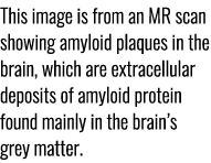 This image is from an MR scan showing amyloid plaques in the brain, which are extracellular deposits of amyloid prote...
