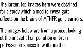 The larger, top images here were obtained for a study which aimed to investigate effects on the brains of MTHFR gene ...