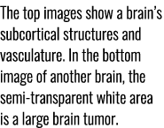 The top images show a brain’s subcortical structures and vasculature. In the bottom image of another brain, the semi ...